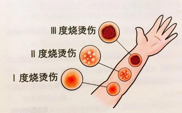 小面积烧烫伤伤口的急救处理指南